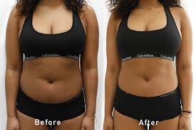 Cryonick (VacuActivus) Iceberg Roller Mini Body Shaper