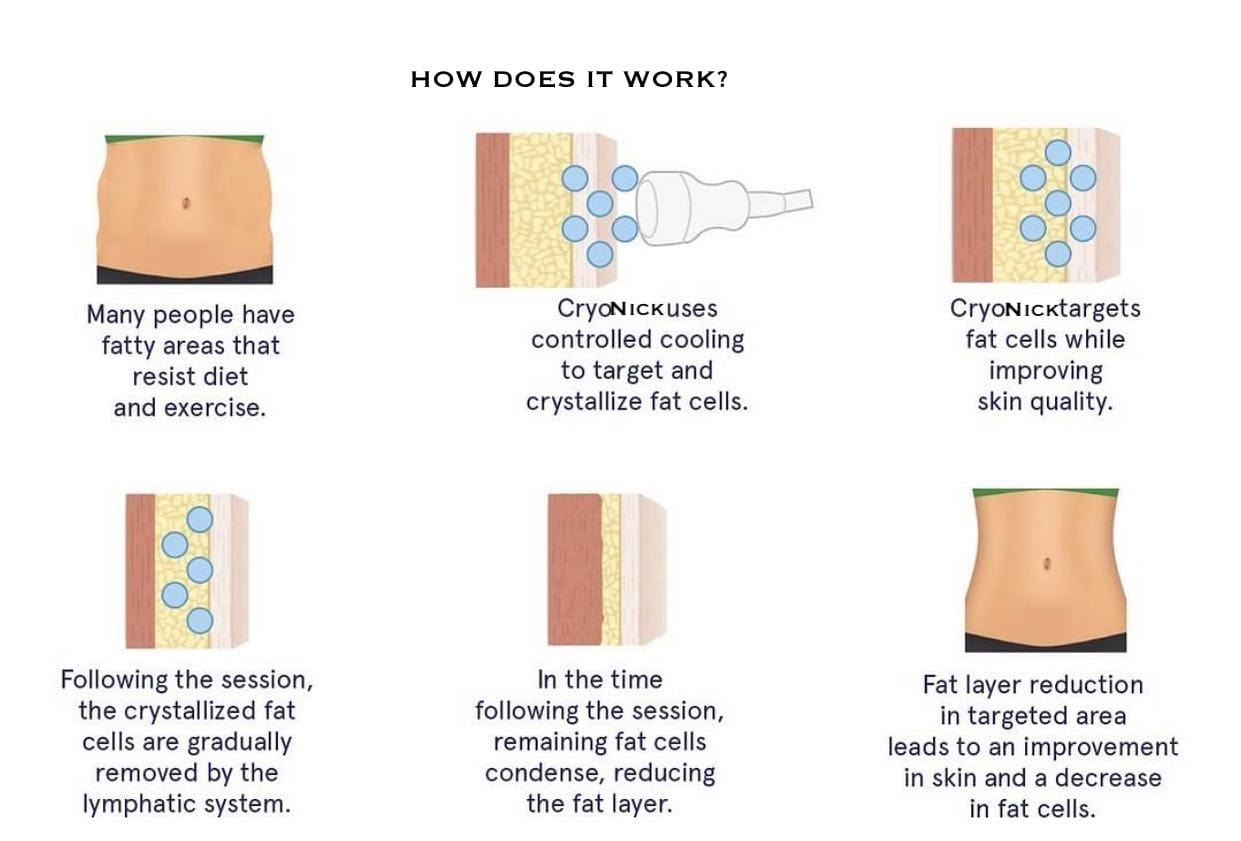 Cryonick (VacuActivus) Iceberg Roller Mini Body Shaper
